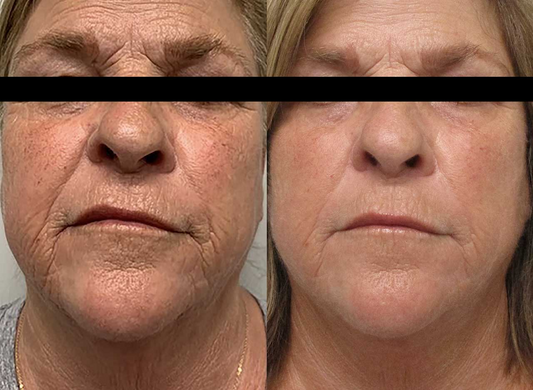 Morpheus 8 Procedure
